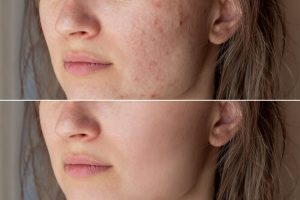 Natural Remedies That Remove Age Spots, Pimples, Moles, And Pores And Skin Tags!